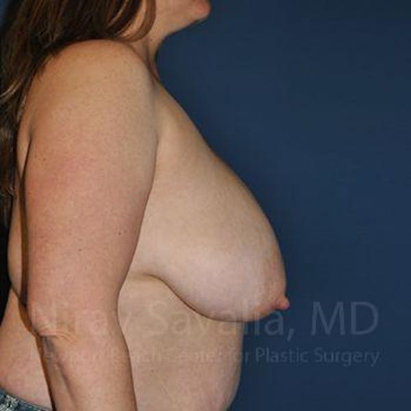 Breast Lift with Implants Before & After Gallery - Patient 1655476 - Before