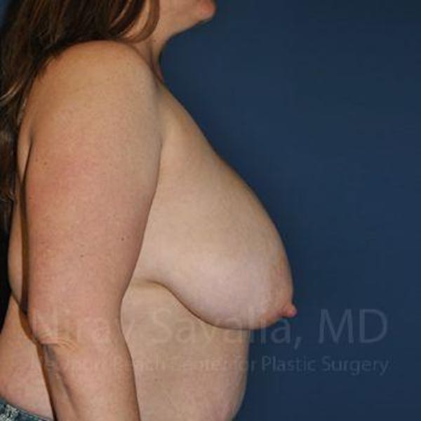 Breast Explantation En Bloc Capsulectomy Before & After Gallery - Patient 1655476 - Before