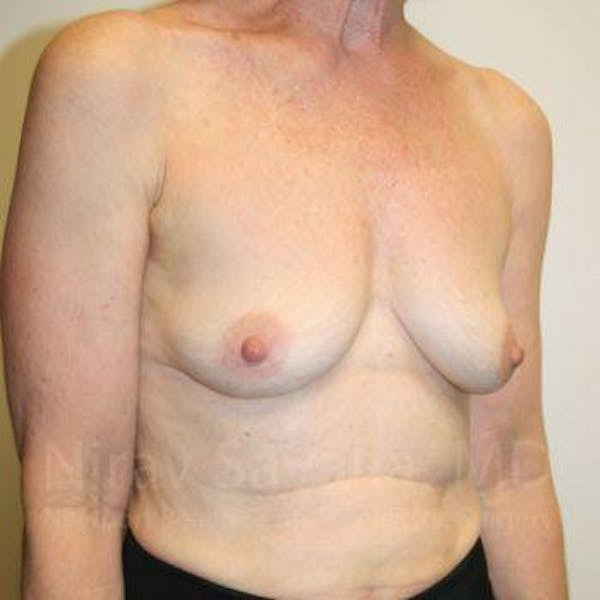 Breast Reduction Before & After Gallery - Patient 1655475 - Before