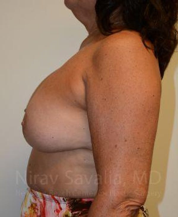 Breast Lift without Implants Before & After Gallery - Patient 1655471 - Before