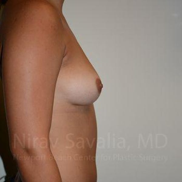 Mastectomy Reconstruction Before & After Gallery - Patient 1655477 - Before