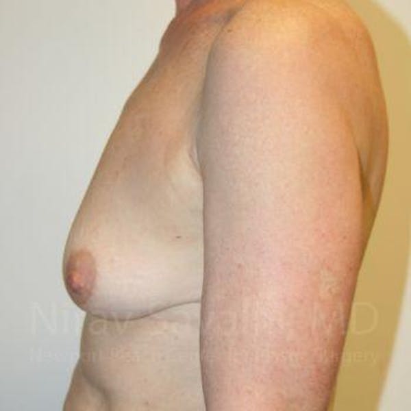 Chin Implants Before & After Gallery - Patient 1655475 - Before