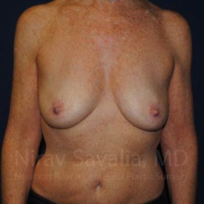 Chin Implants Before & After Gallery - Patient 1655481 - Before