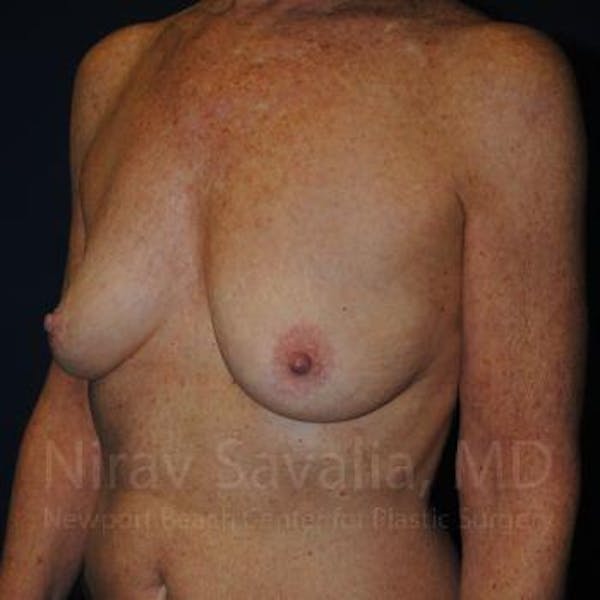 Breast Lift without Implants Before & After Gallery - Patient 1655481 - Before