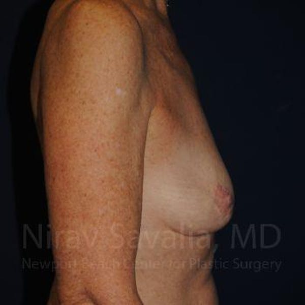 Abdominoplasty Tummy Tuck Before & After Gallery - Patient 1655481 - Before