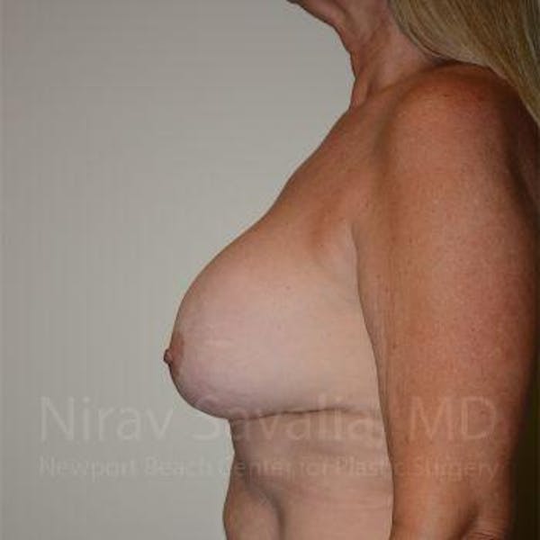 Chin Implants Before & After Gallery - Patient 1655483 - Before