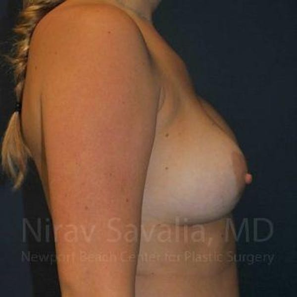Breast Lift with Implants Before & After Gallery - Patient 1655486 - Before