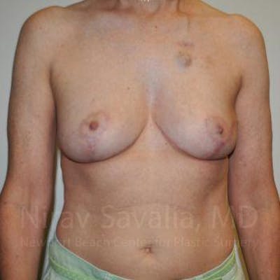 Breast Reduction Before & After Gallery - Patient 1655487 - After
