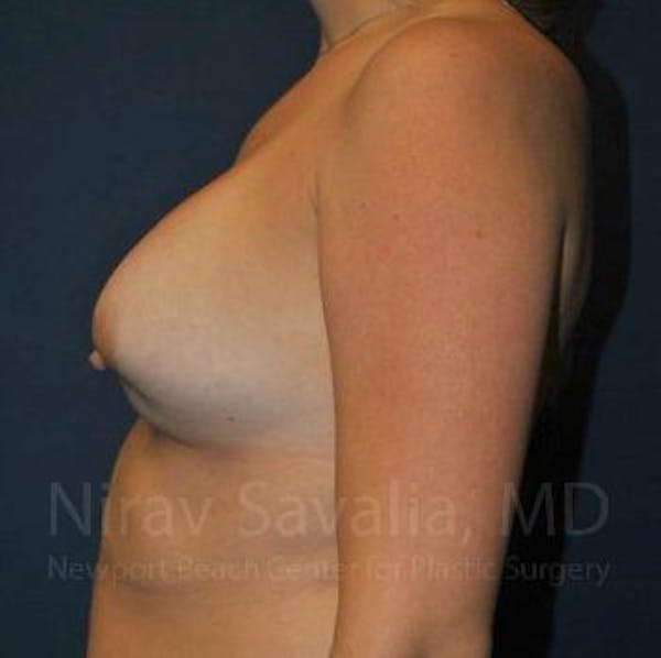 Breast Lift with Implants Before & After Gallery - Patient 1655486 - Before