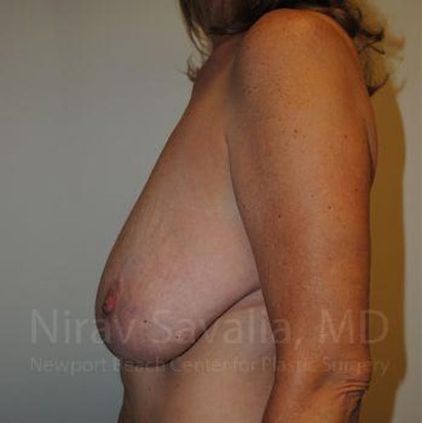 Breast Explantation En Bloc Capsulectomy Before & After Gallery - Patient 1655489 - Before