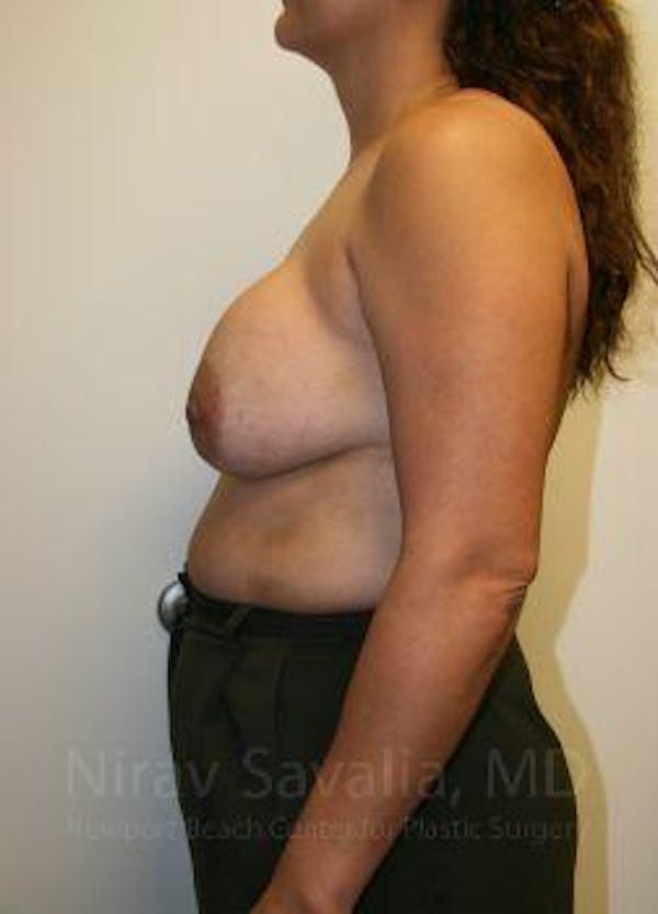 Breast Reduction Before & After Gallery - Patient 1655490 - Before