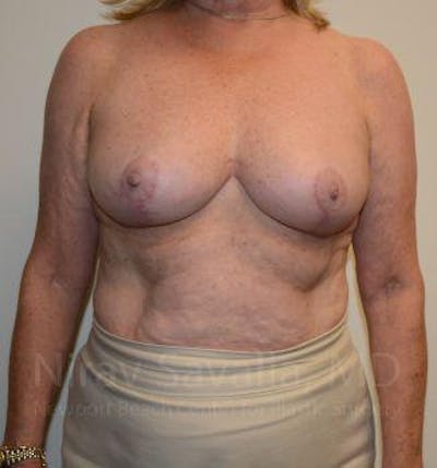 Breast Explantation En Bloc Capsulectomy Before & After Gallery - Patient 1655496 - After