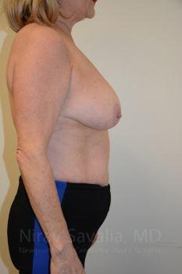 Oncoplastic Reconstruction Before & After Gallery - Patient 1655496 - Before