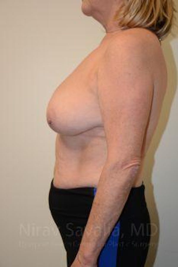 Breast Lift with Implants Before & After Gallery - Patient 1655496 - Before