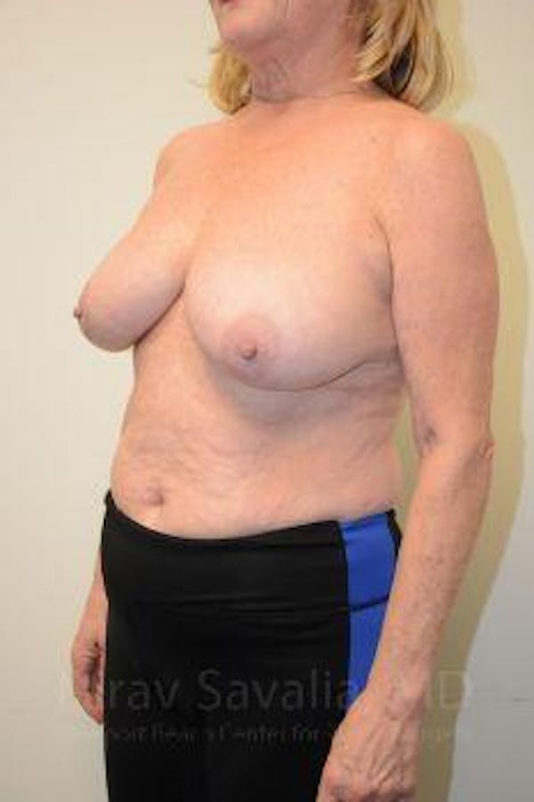 Breast Explantation En Bloc Capsulectomy Before & After Gallery - Patient 1655496 - Before