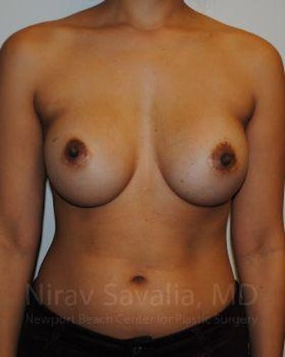 Breast Explantation En Bloc Capsulectomy Before & After Gallery - Patient 1655498 - Before