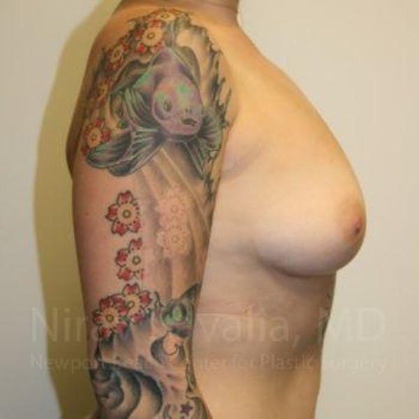 Mastectomy Reconstruction Before & After Gallery - Patient 1655500 - Before