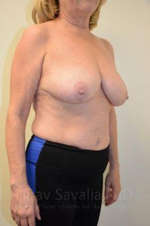 Breast Explantation En Bloc Capsulectomy Before & After Gallery - Patient 1655496 - Before