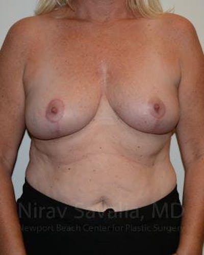 Breast Explantation En Bloc Capsulectomy Before & After Gallery - Patient 1655499 - After