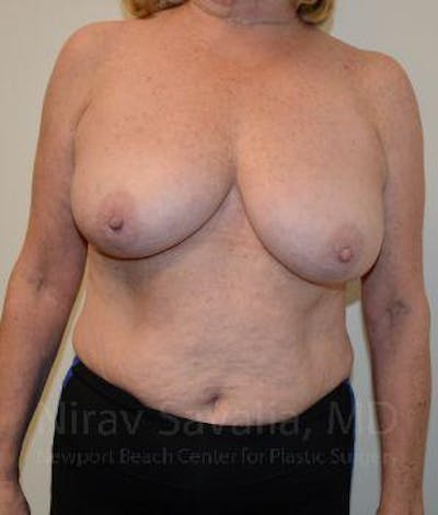 Chin Implants Before & After Gallery - Patient 1655501 - Before