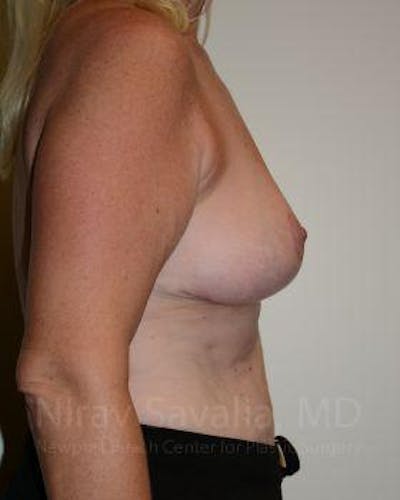 Mastectomy Reconstruction Before & After Gallery - Patient 1655499 - After