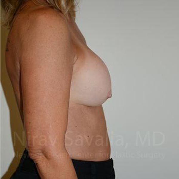 Breast Explantation En Bloc Capsulectomy Before & After Gallery - Patient 1655503 - Before