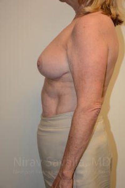 Breast Explantation En Bloc Capsulectomy Before & After Gallery - Patient 1655501 - After