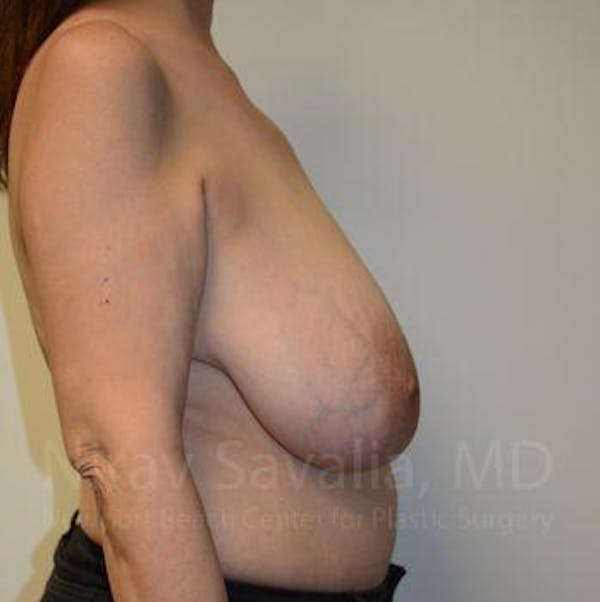 Breast Reduction Before & After Gallery - Patient 1655505 - Before