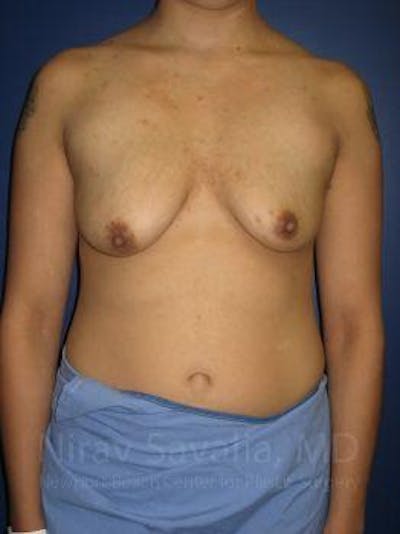 Breast Explantation En Bloc Capsulectomy Before & After Gallery - Patient 1655508 - Before