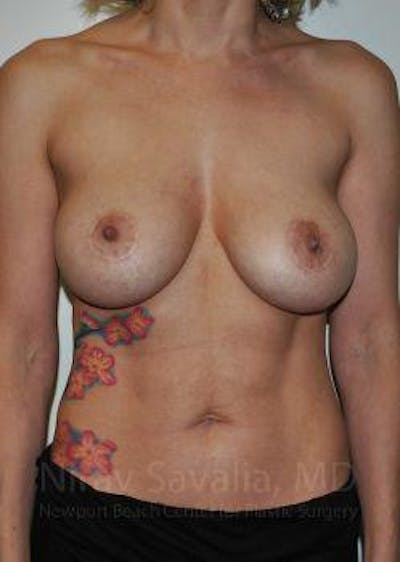 Breast Explantation En Bloc Capsulectomy Before & After Gallery - Patient 1655507 - Before