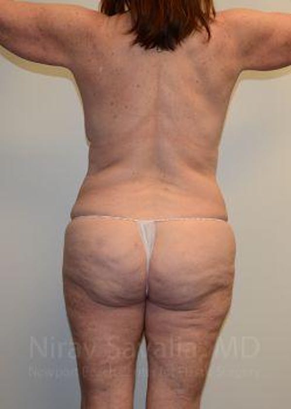 Oncoplastic Reconstruction Before & After Gallery - Patient 1655509 - Before