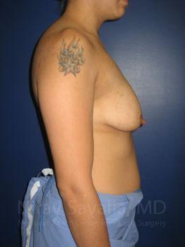 Oncoplastic Reconstruction Before & After Gallery - Patient 1655508 - Before