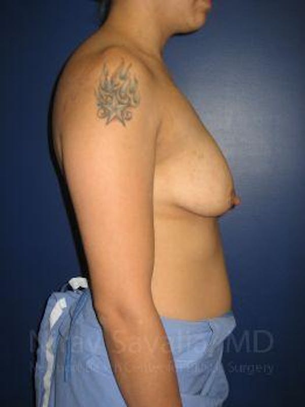 Breast Explantation En Bloc Capsulectomy Before & After Gallery - Patient 1655508 - Before