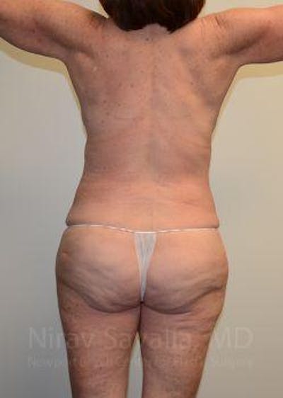 Thigh Lift Before & After Gallery - Patient 1655509 - After