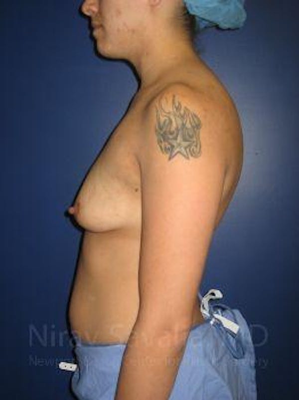 Oncoplastic Reconstruction Before & After Gallery - Patient 1655508 - Before