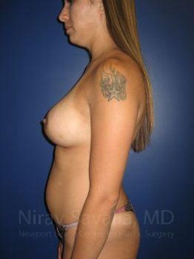 Mommy Makeover Before & After Gallery - Patient 1655508 - After