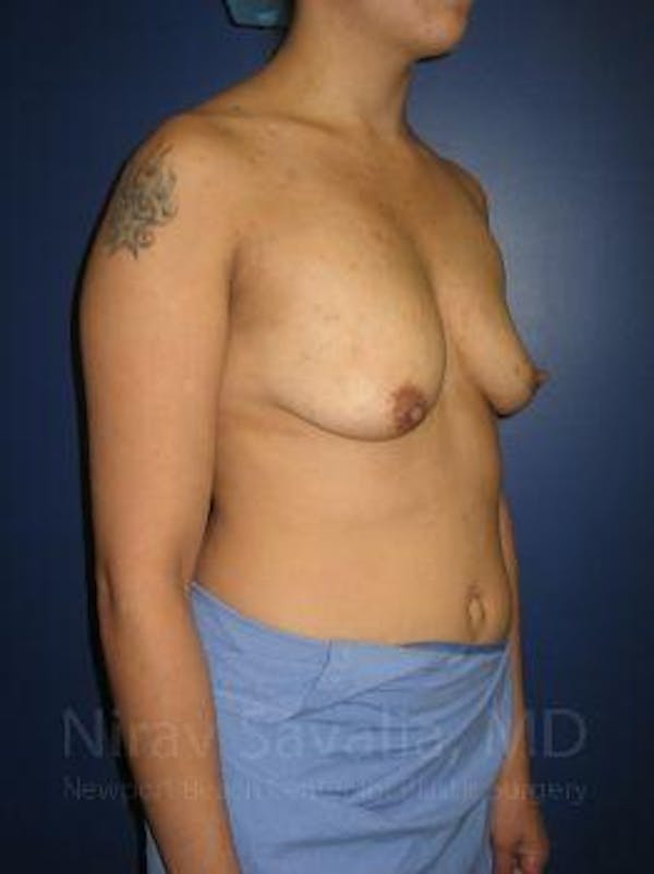 Breast Explantation En Bloc Capsulectomy Before & After Gallery - Patient 1655508 - Before