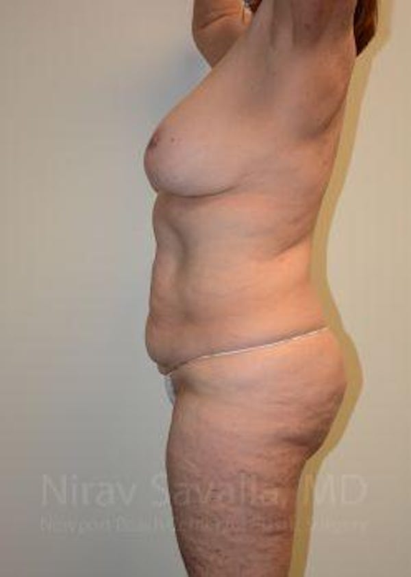 Breast Reduction Before & After Gallery - Patient 1655509 - Before