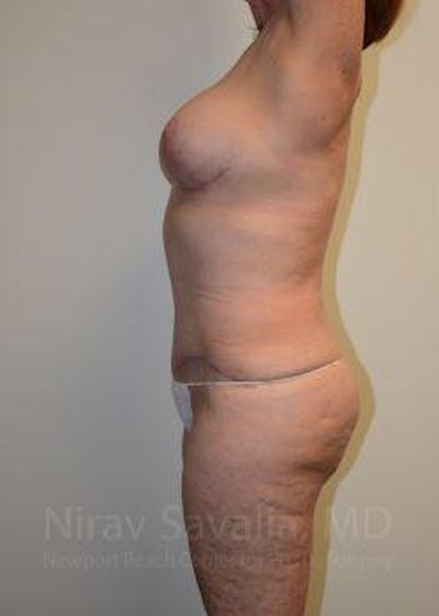 Breast Lift with Implants Before & After Gallery - Patient 1655509 - After