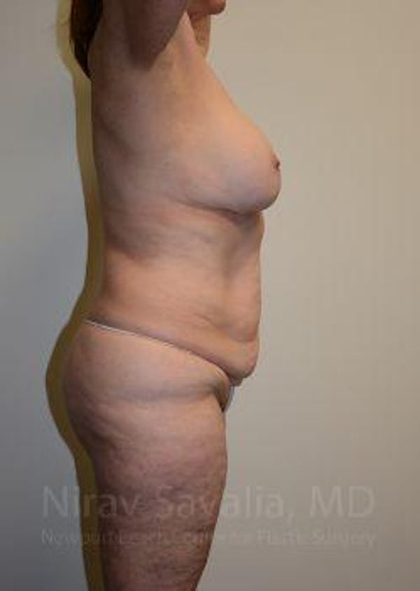 Oncoplastic Reconstruction Before & After Gallery - Patient 1655509 - Before