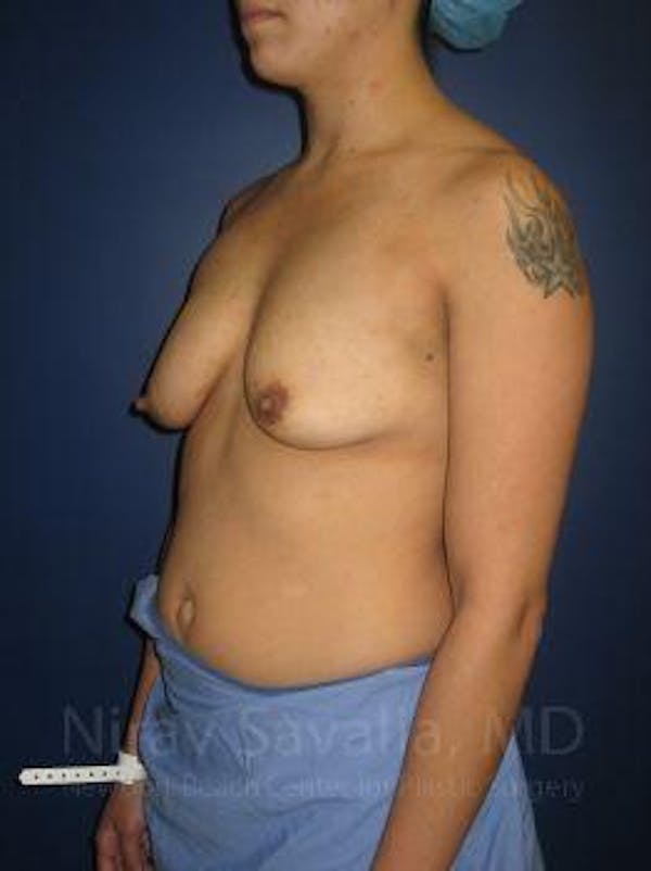 Breast Explantation En Bloc Capsulectomy Before & After Gallery - Patient 1655508 - Before