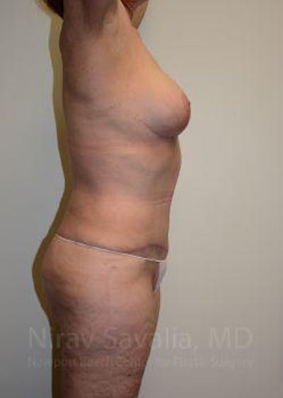 Breast Explantation En Bloc Capsulectomy Before & After Gallery - Patient 1655509 - After