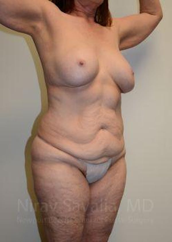 Breast Lift with Implants Before & After Gallery - Patient 1655509 - Before