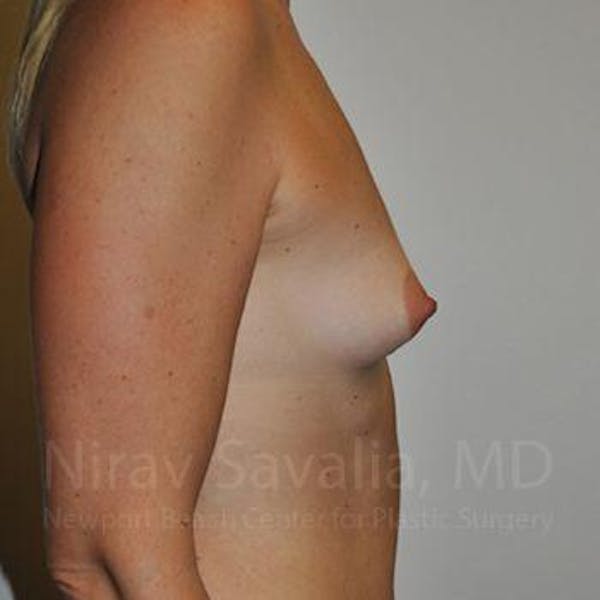 Breast Lift with Implants Before & After Gallery - Patient 1655512 - Before