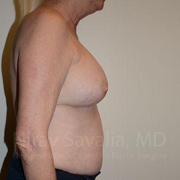 Breast Reduction Before & After Gallery - Patient 1655513 - Before