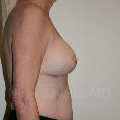 Thigh Lift Before & After Gallery - Patient 1655513 - After