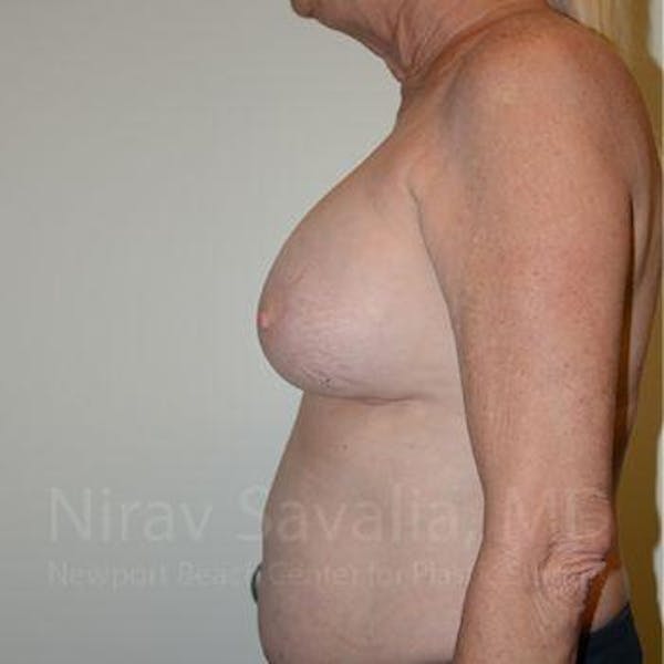 Breast Lift with Implants Before & After Gallery - Patient 1655513 - Before