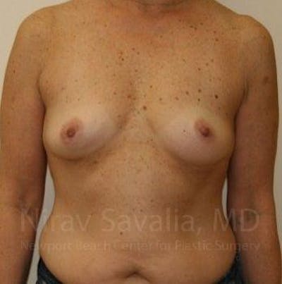 Breast Explantation En Bloc Capsulectomy Before & After Gallery - Patient 1655519 - Before