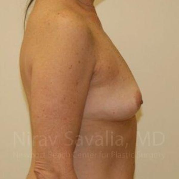 Oncoplastic Reconstruction Before & After Gallery - Patient 1655519 - Before