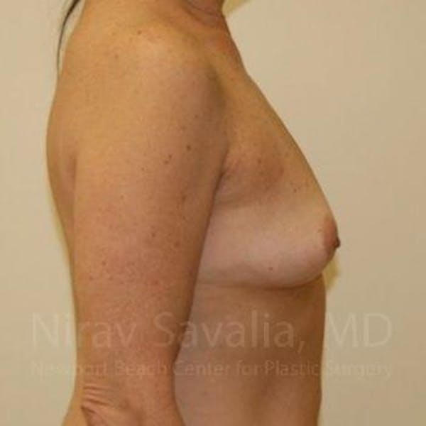 Breast Explantation En Bloc Capsulectomy Before & After Gallery - Patient 1655519 - Before